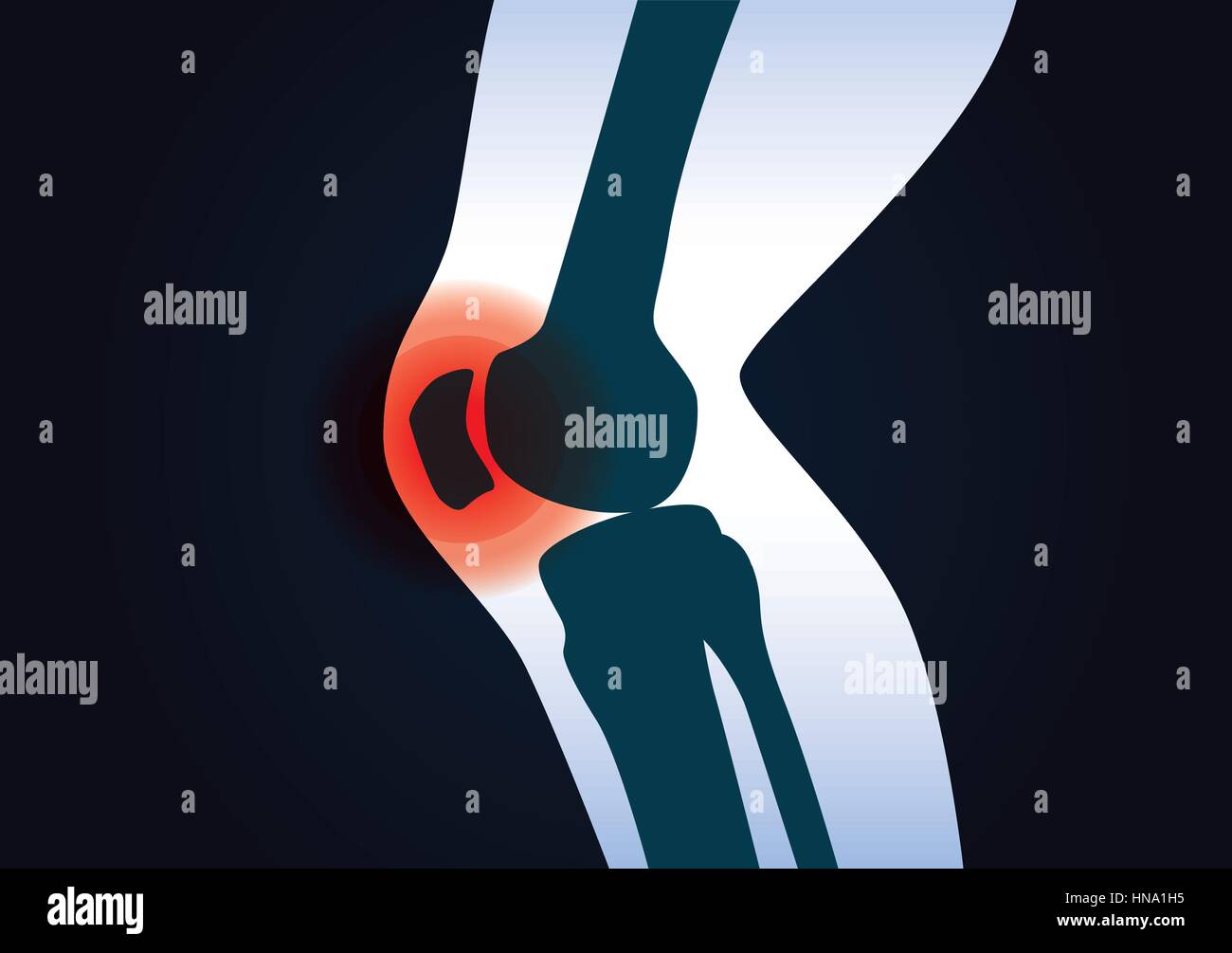 Rotes Signal im Kniebereich. Diese Illustration über menschliche Beinverletzung. Stock Vektor