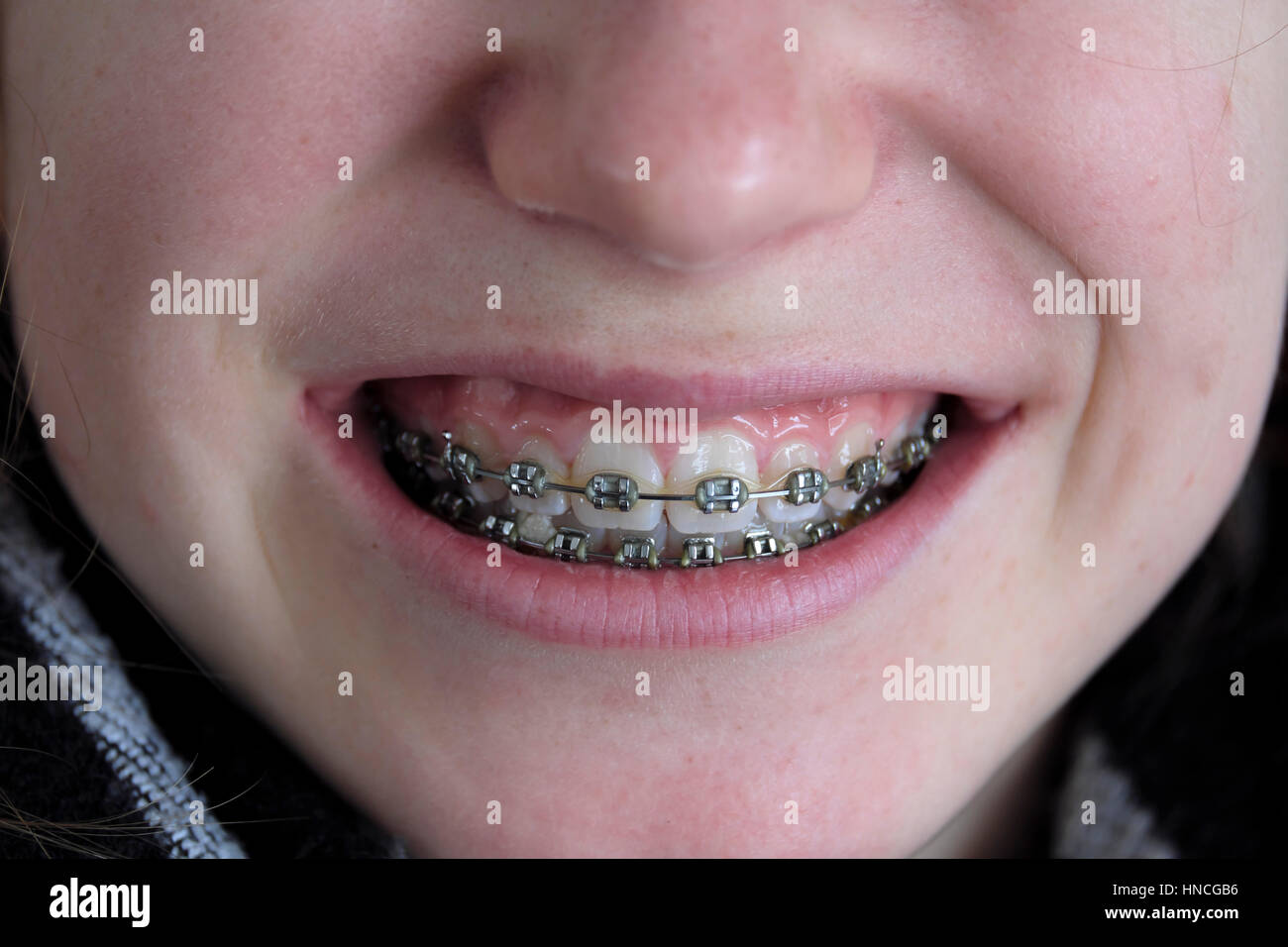 Feste Zahnspangen, Mund eines Mädchens, Teenager, Upper Bavaria, Bavaria, Germany Stockfoto