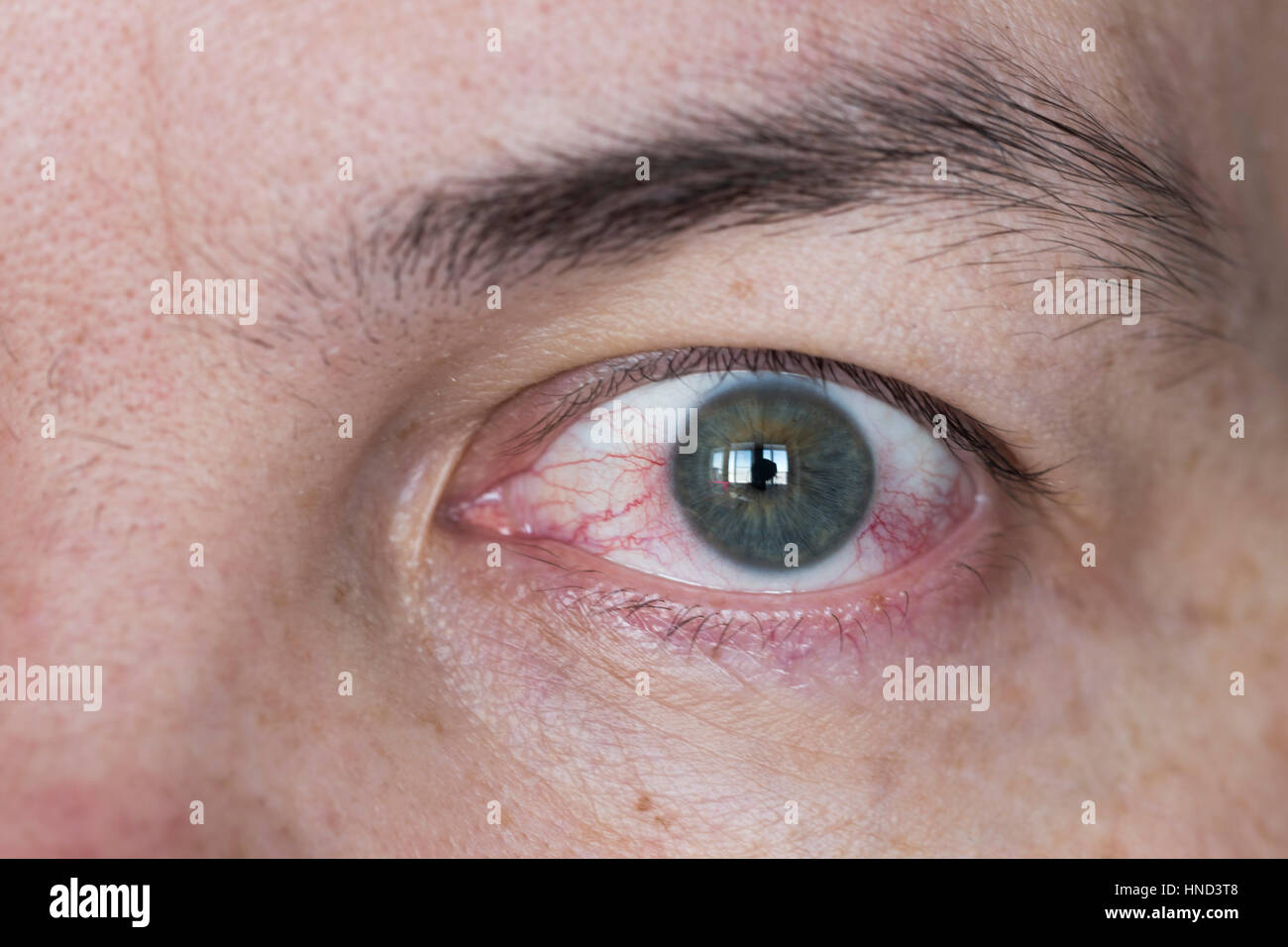 Nahaufnahme von weiten, offenen rote und gereizte Augen Stockfotografie -  Alamy