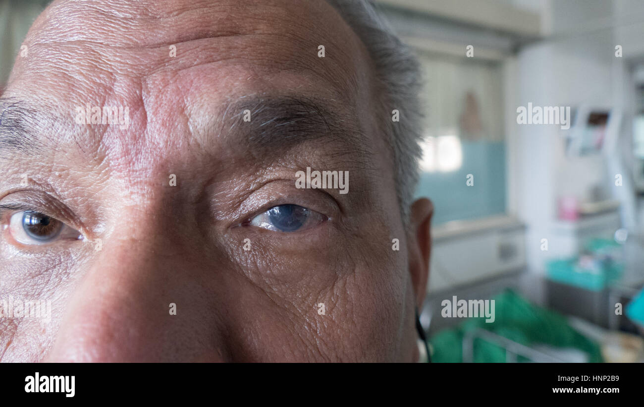 Keratopathie bullöse Zustand im Auge von älteren Patienten vor Eindringen  Keratoplastik Stockfotografie - Alamy