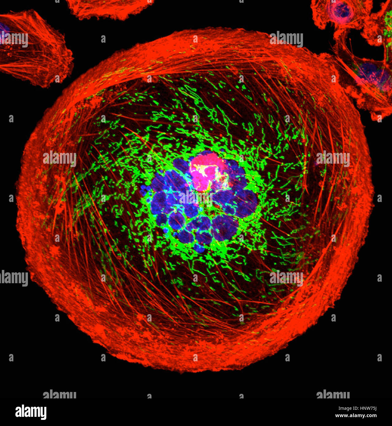 Mikroskopische Bild der polyploid Riesen Krebszelle Stockfoto