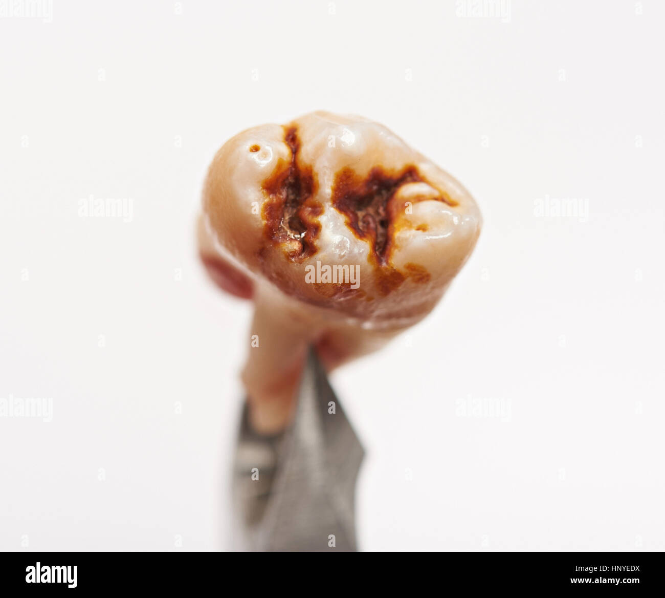 Beschädigt durch Hohlraum Zähne Closeup isoliert auf weißem Hintergrund Stockfoto