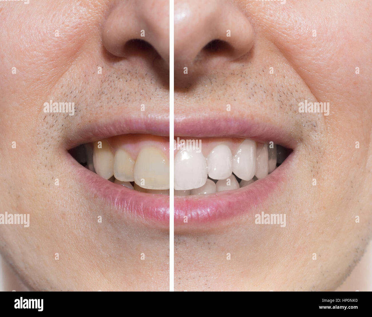 Zähne vor und nach Stockfoto