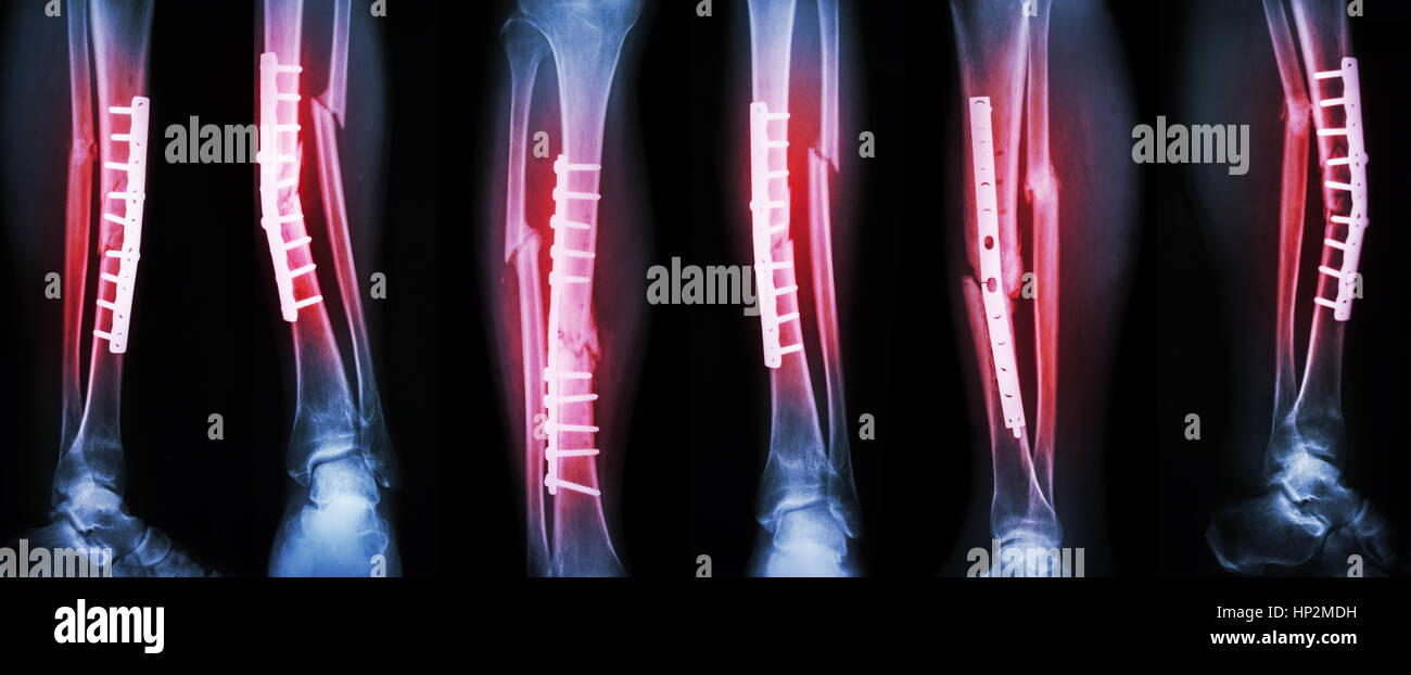 Kollektion Bild Bein Fraktur und chirurgische Behandlung durch interne Fixation mit Platte und Schrauben. Tibia und Fibula Knochen zu brechen. Stockfoto