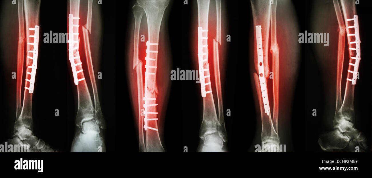 Kollektion Bild Bein Fraktur und chirurgische Behandlung durch interne Fixation mit Platte und Schrauben. Tibia und Fibula Knochen zu brechen. Stockfoto