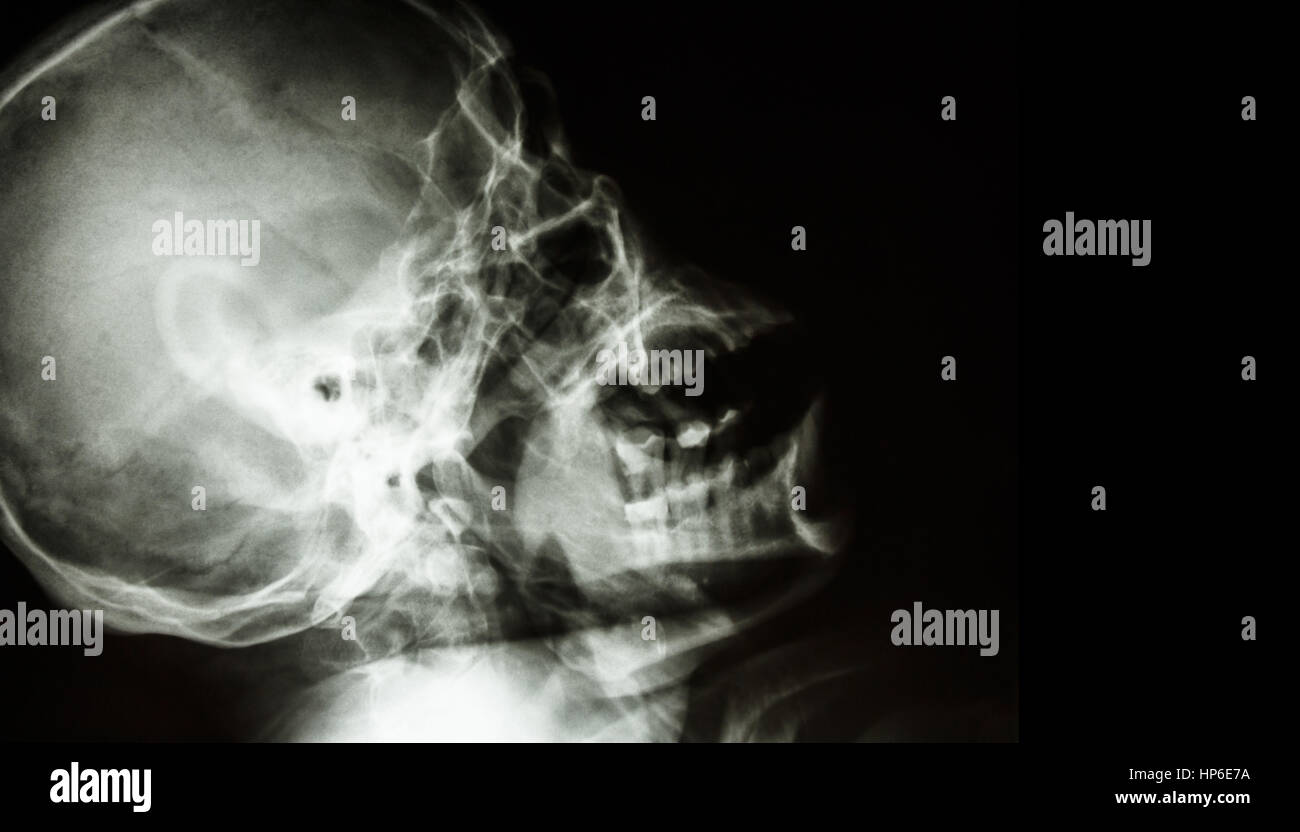 Der Roentgenfilm des normalen menschlichen Schädel. seitliche Ansicht. leeren Bereich auf der rechten Seite. Stockfoto
