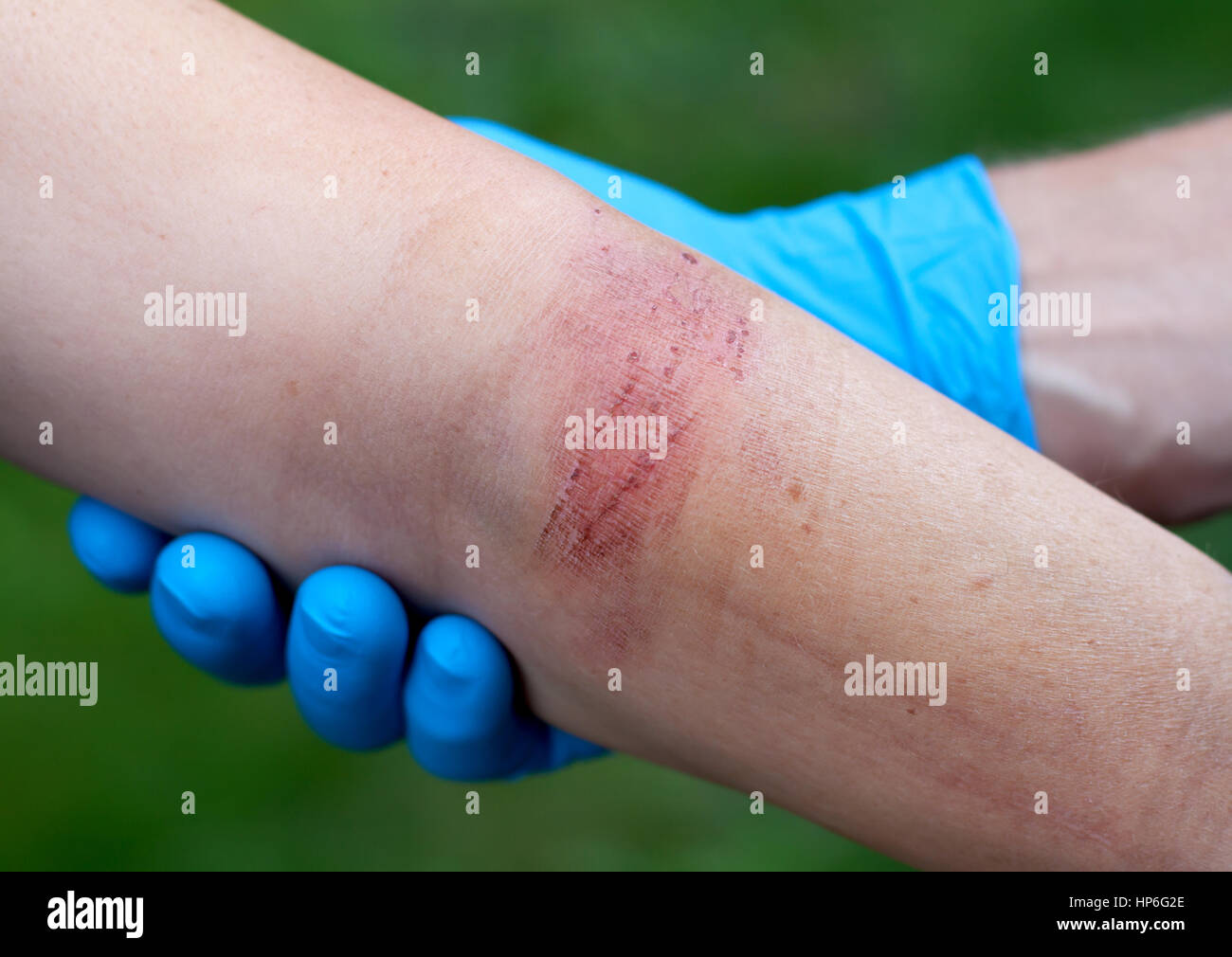 Verbrannter arm Fotos und Bildmaterial in hoher Auflösung Alamy