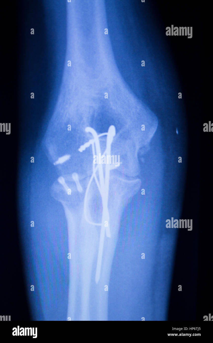 Ellenbogen gemeinsame Titanium Metall moderne Implantat Röntgen-Test-Scan-Ergebnis nach der Operation für Traumatologie und Orthopädie. Stockfoto