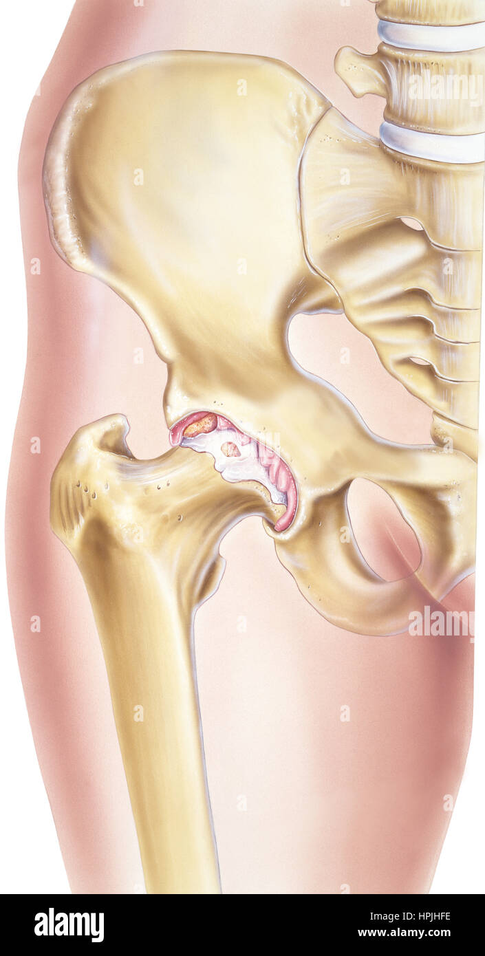 Arthrose ist eine Begleitsymptomatik Degenerative Gelenkerkrankung durch den Zusammenbruch der das Gelenk Knorpel geprägt. Knorpel, die die Bo Kissen Stockfoto