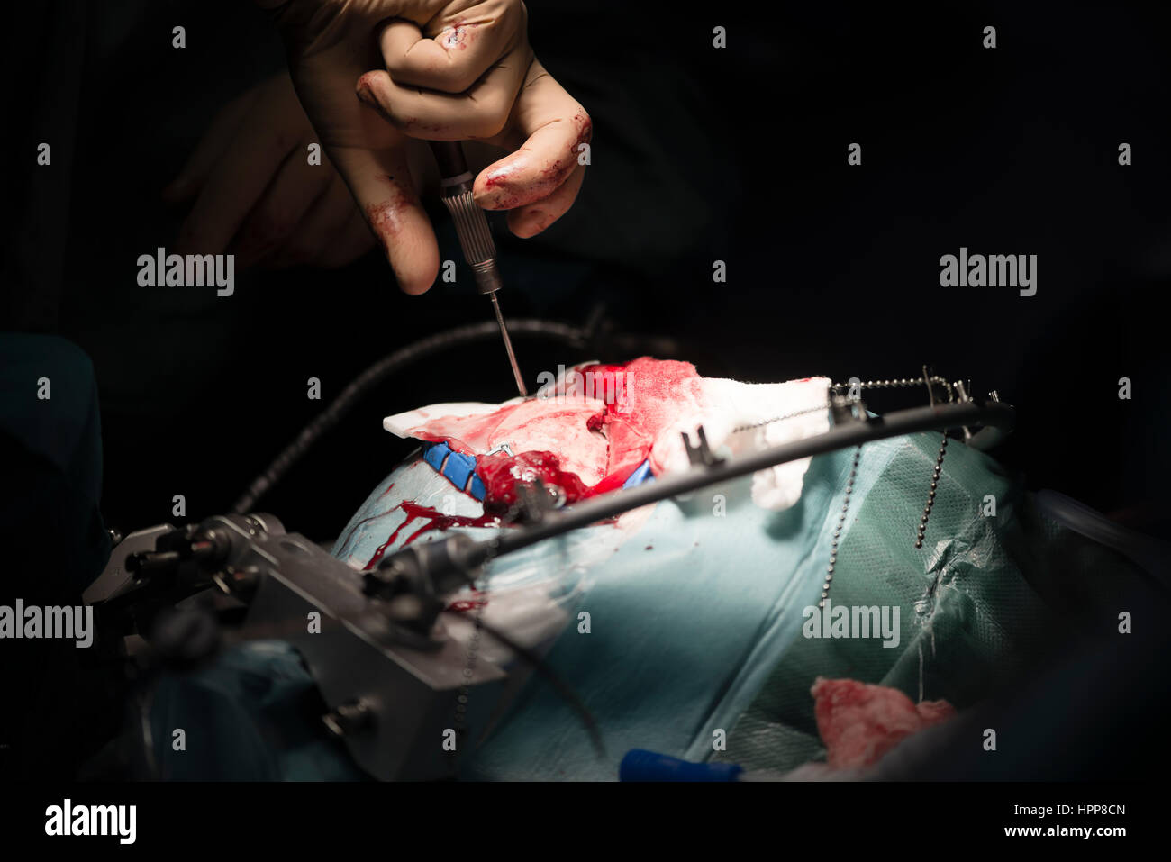 Neurochirurg Schrauben die Schädelknochen während einer operation Stockfoto