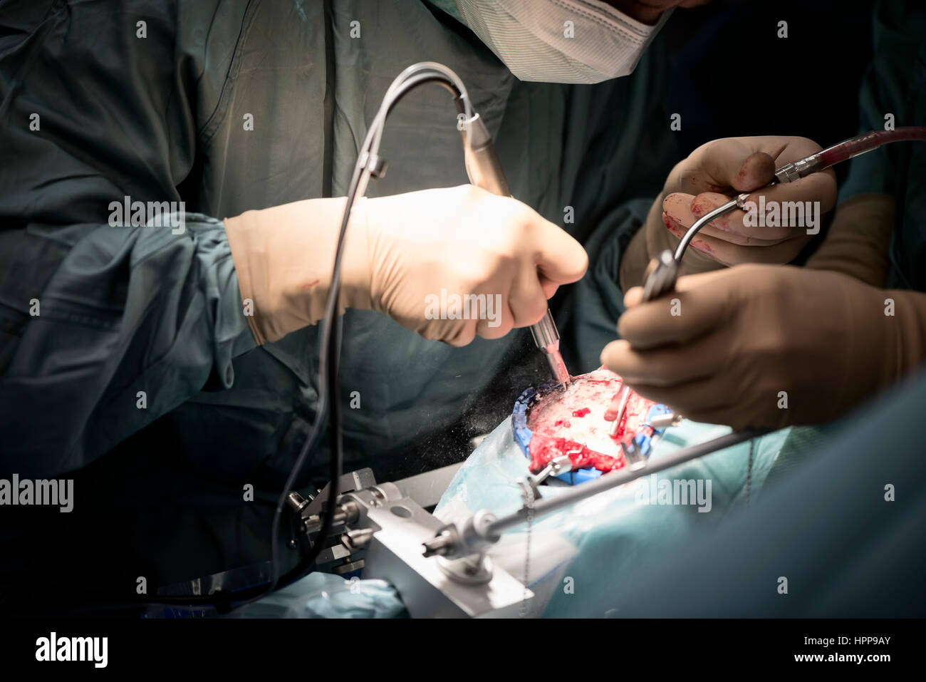 Neurochirurgen, die Eröffnung des Schädels während einer operation Stockfoto