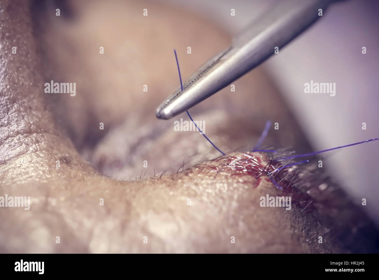 Naht der Wunde durch chirurgische Thread Stockfoto