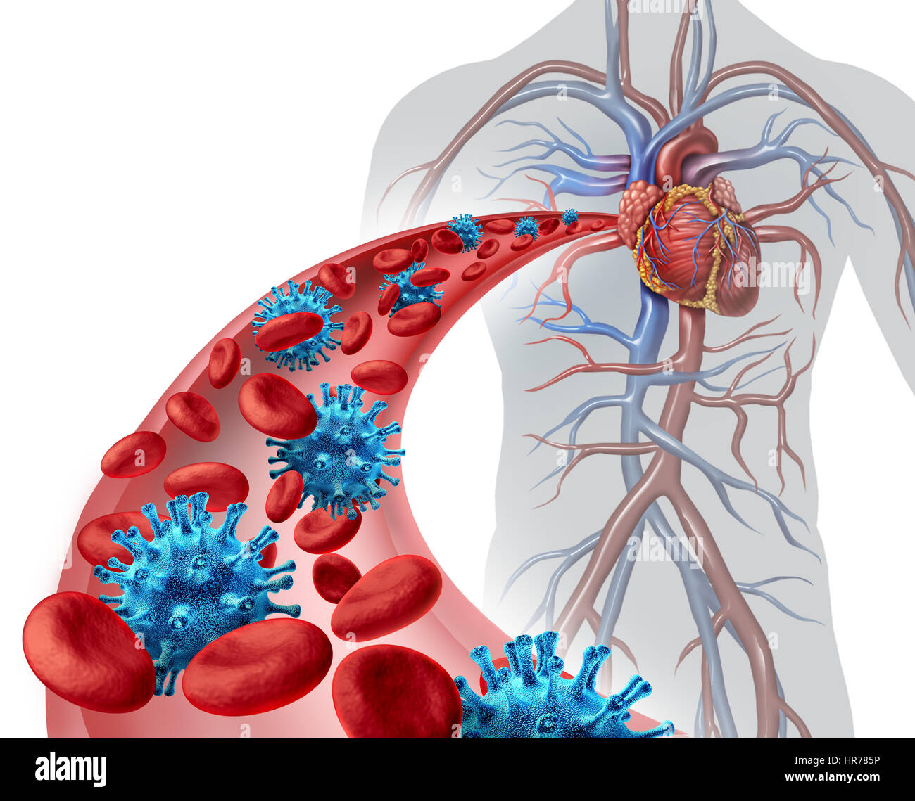 Blut-Virus-Infektion medizinisches Konzept als einen menschlichen Körper mit einer Arterie mit mikroskopisch kleinen Erreger und Erythrozyten von Krankheit bedroht. Stockfoto