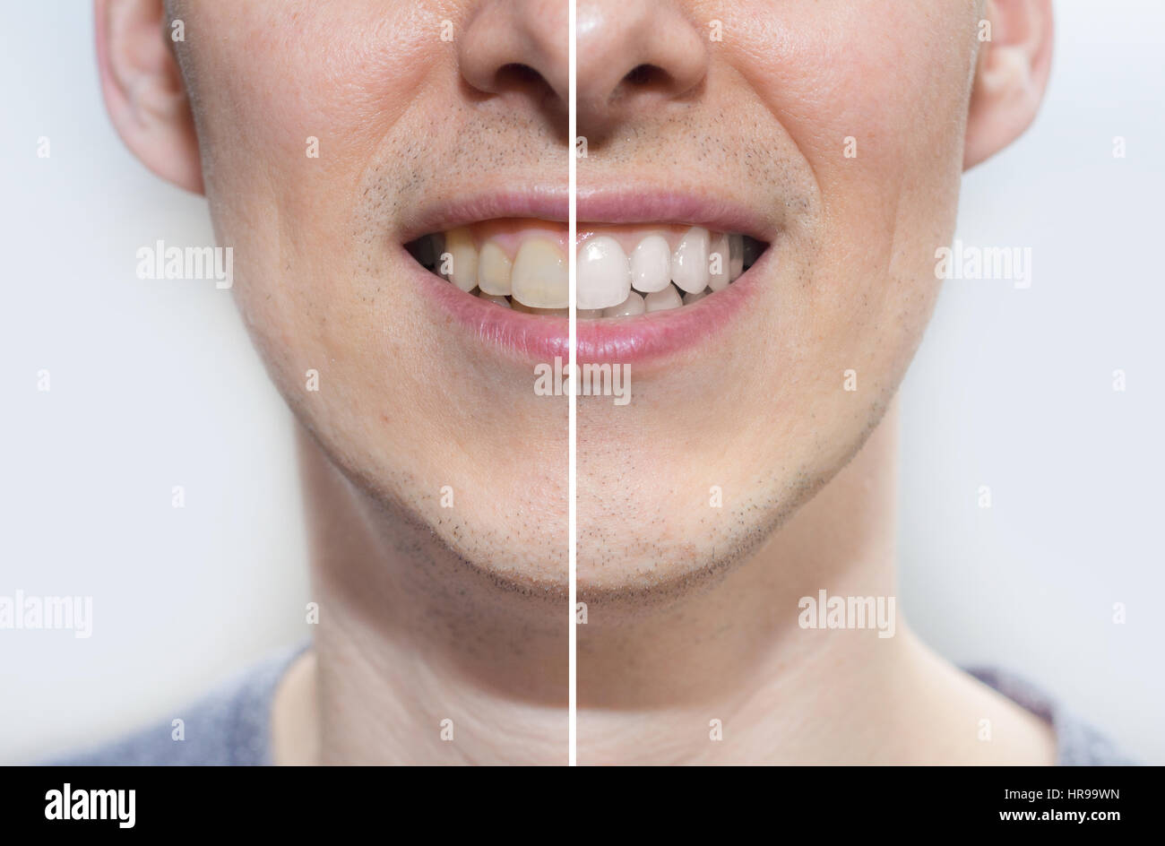 Zähne vor und nach Stockfoto