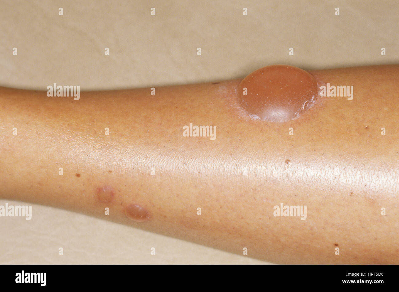 Allergische Reaktion Auf Muckenstich Stockfotografie Alamy