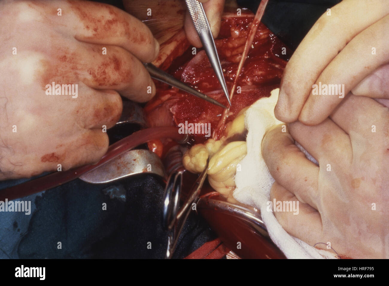 Distale Graft vorbereiten Herzen Stockfoto
