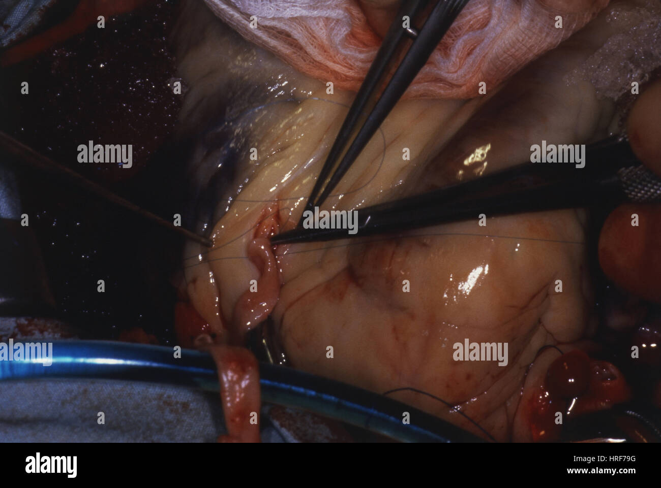 Bypass-Operation Stockfoto