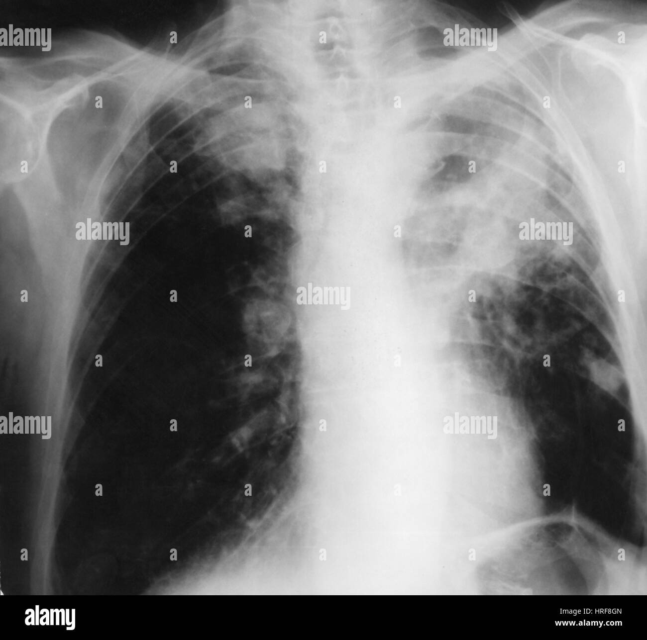 X-ray von Lungenkrebs Stockfoto
