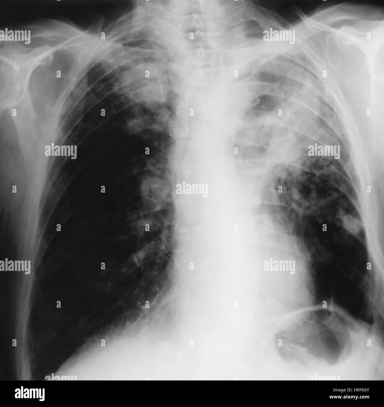 X-ray von Lungenkrebs Stockfoto