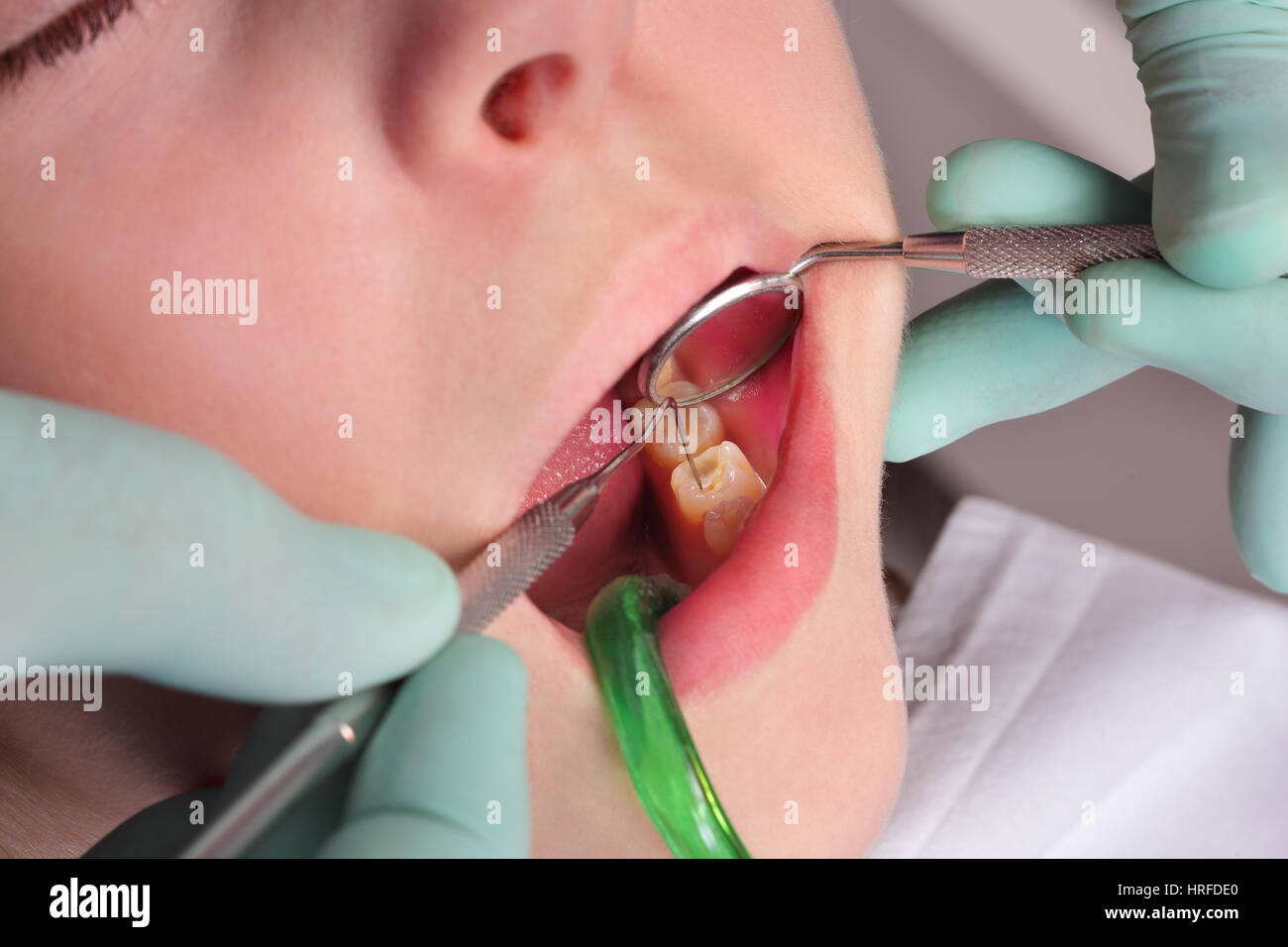 Nahaufnahme von Loch, Hohlraum im Zahn nach dem Bohren, bei der Besetzung  von dental Werkzeug und Spiegel Stockfotografie - Alamy