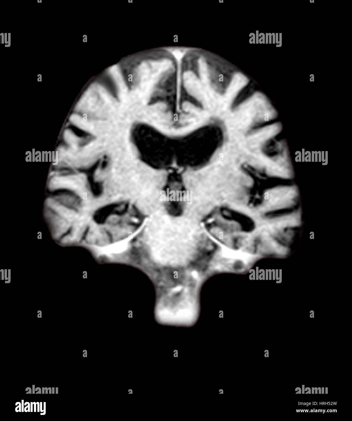 MRT des Gehirns mit der Alzheimer-Krankheit Stockfoto