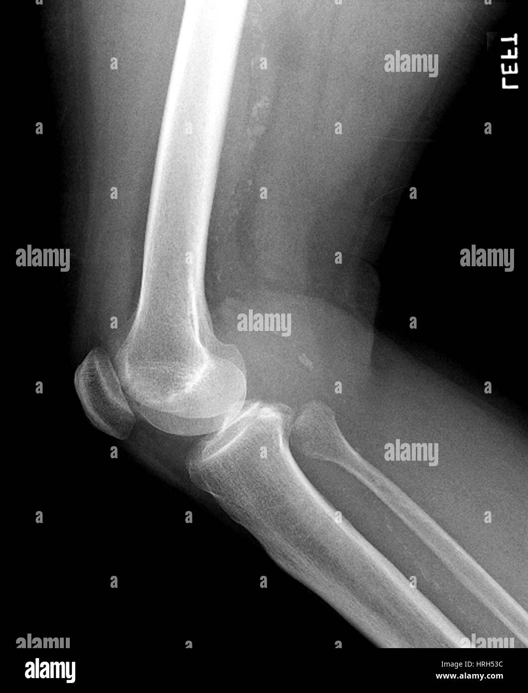 Seitlichen Röntgen des Knies Stockfoto