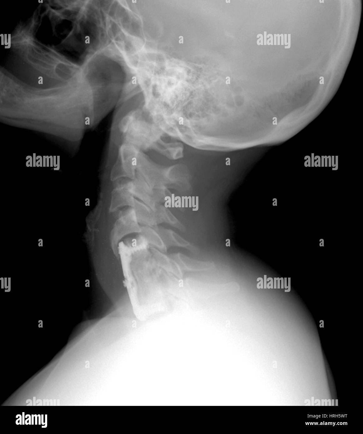 Halswirbelsäule Stockfoto