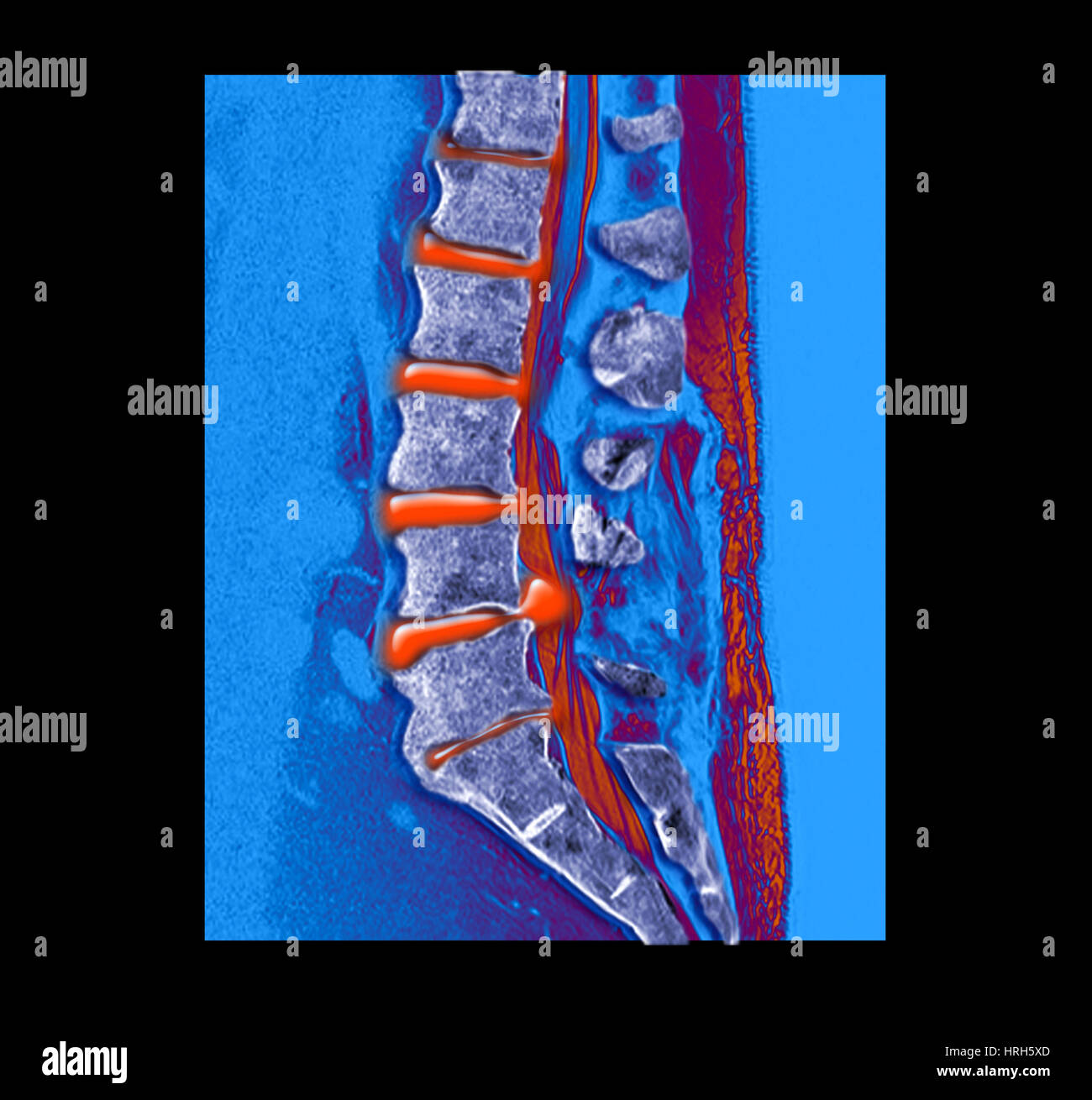 Bandscheibenvorfall Stockfoto