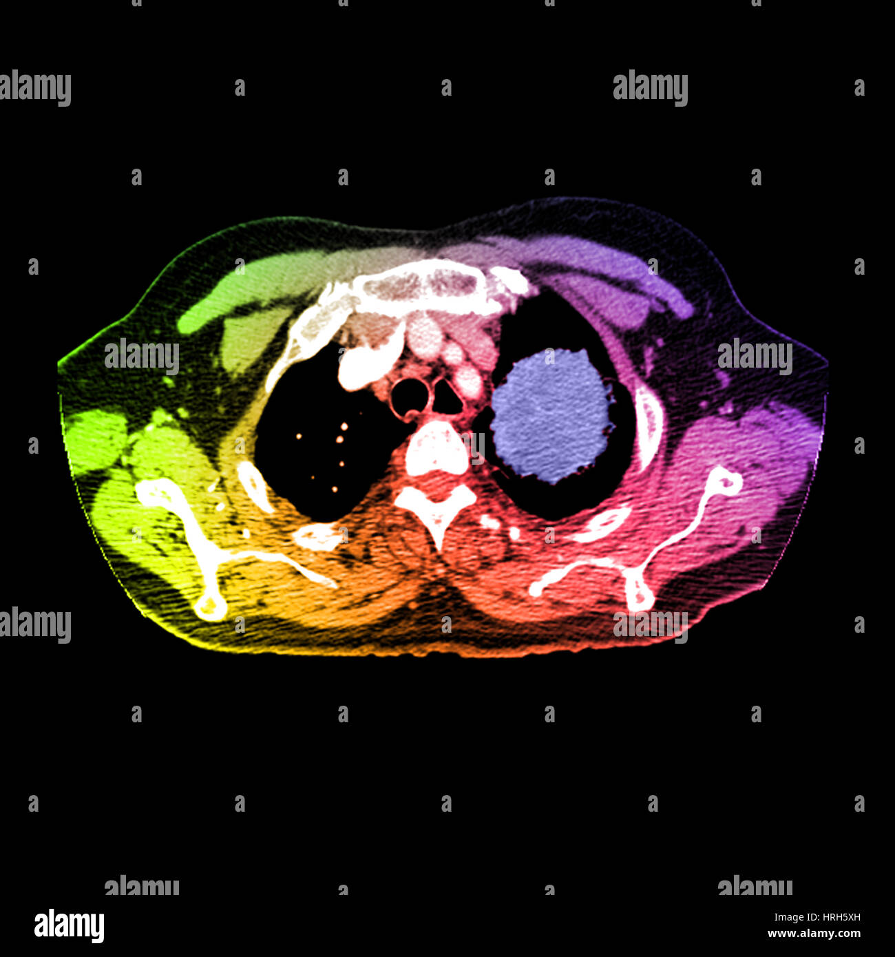 Lungenkrebs Stockfoto
