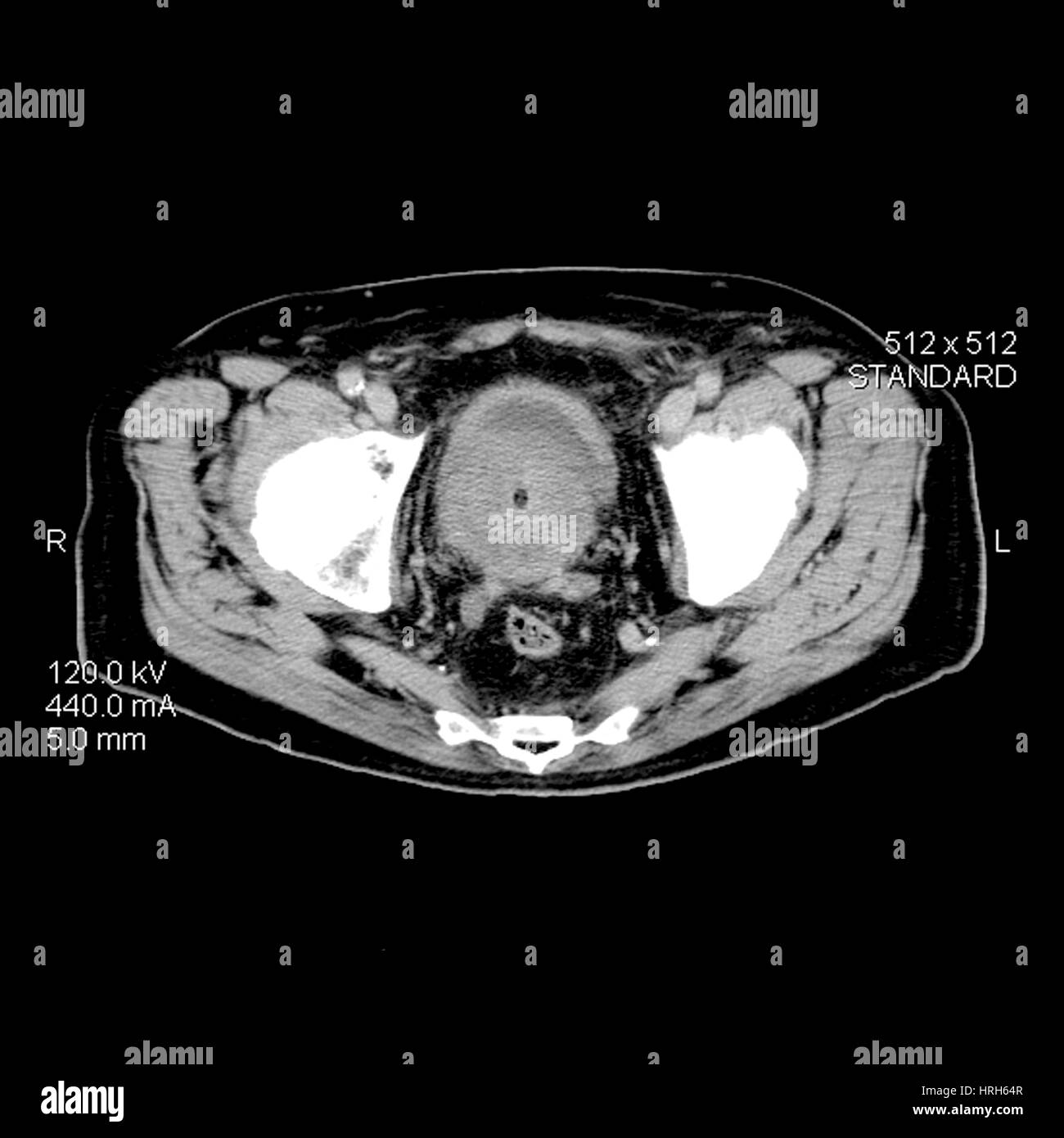 CT-Prostata-Krebs Stockfoto