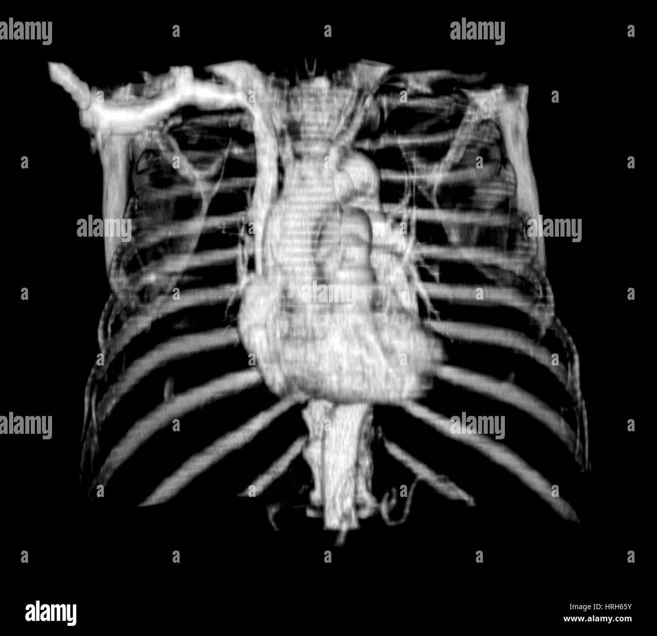 3D CT-Rekonstruktion des Herzens Stockfoto