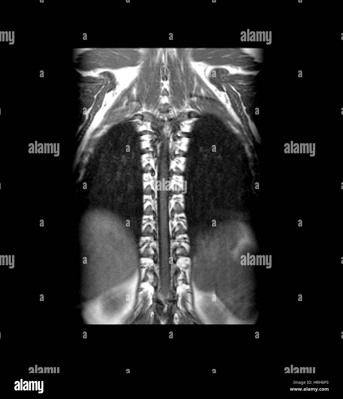 Normalen MRI des thorakalen Rückenmarks Stockfoto