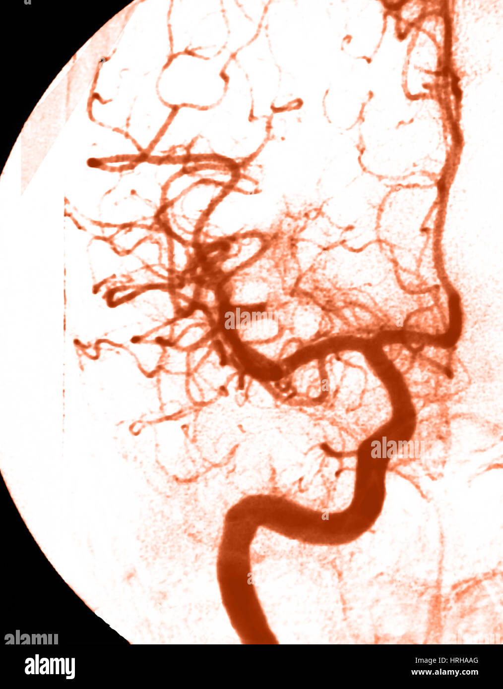 Zerebrale Angiographie Stockfoto