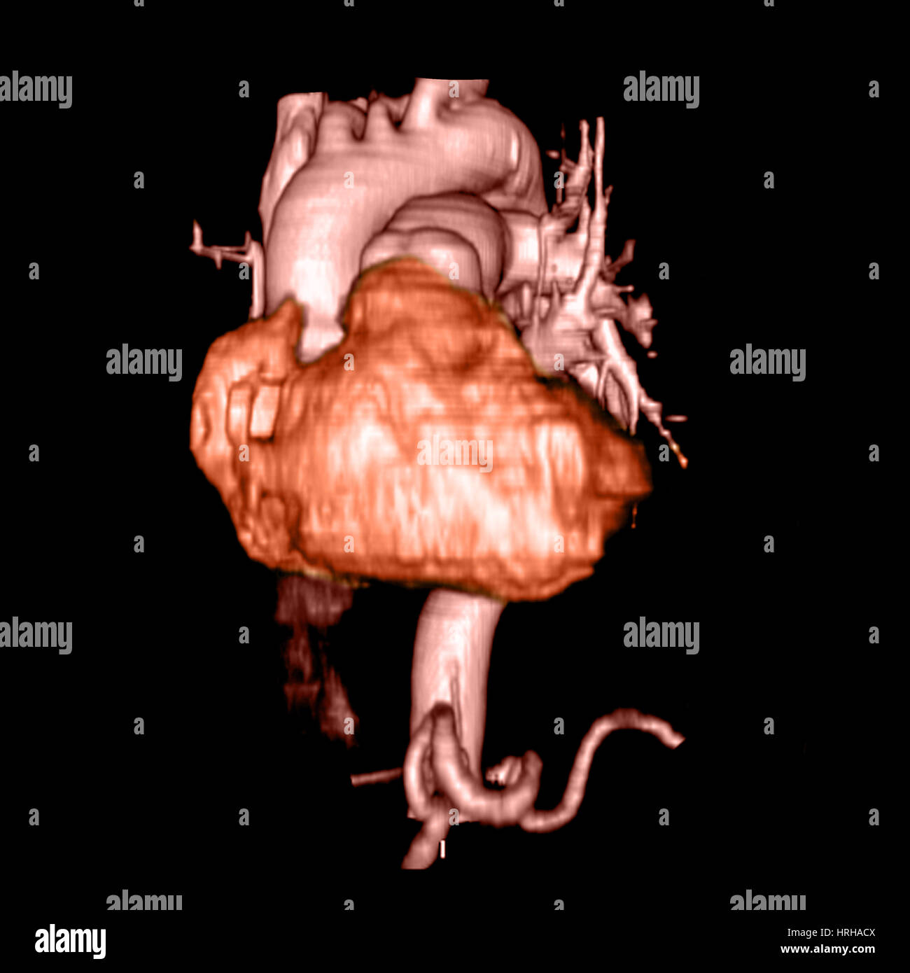 3D CTA des Herzens Stockfoto