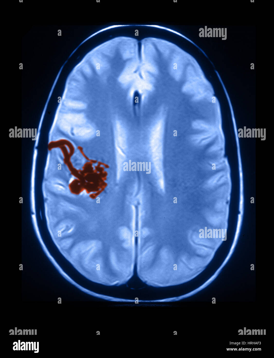 MRI des arteriellen und venösen Fehlbildungen Stockfoto