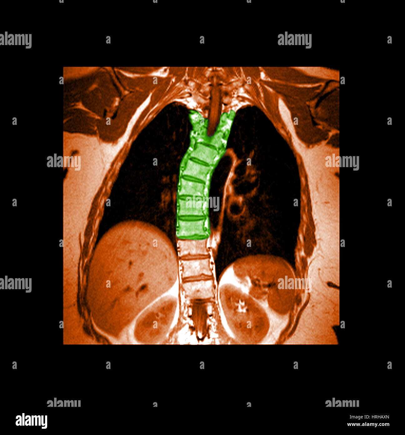MRT der thorakalen Skoliose Stockfoto