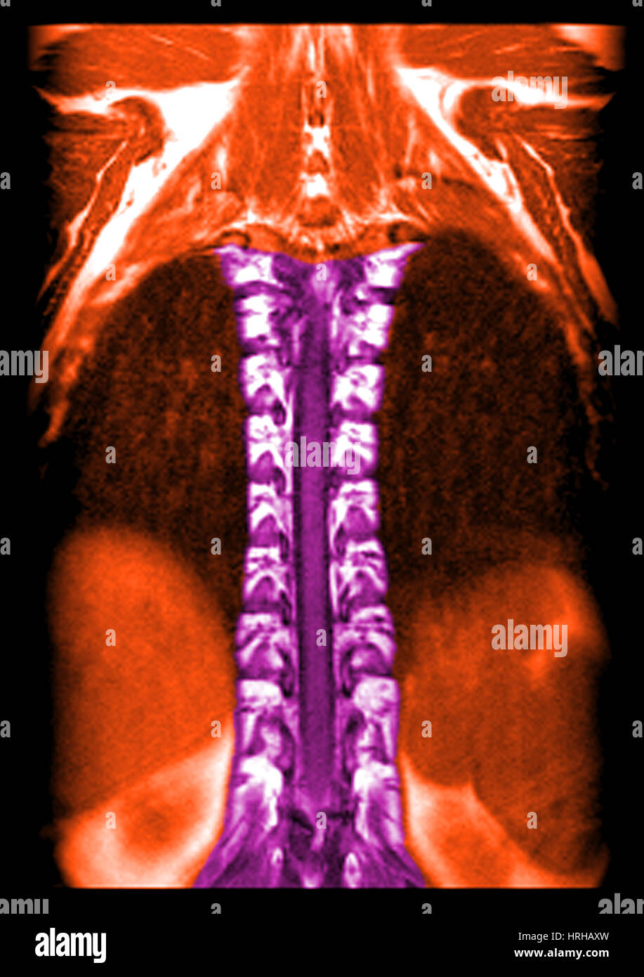 MRI des normalen thorakalen Rückenmarks Stockfoto