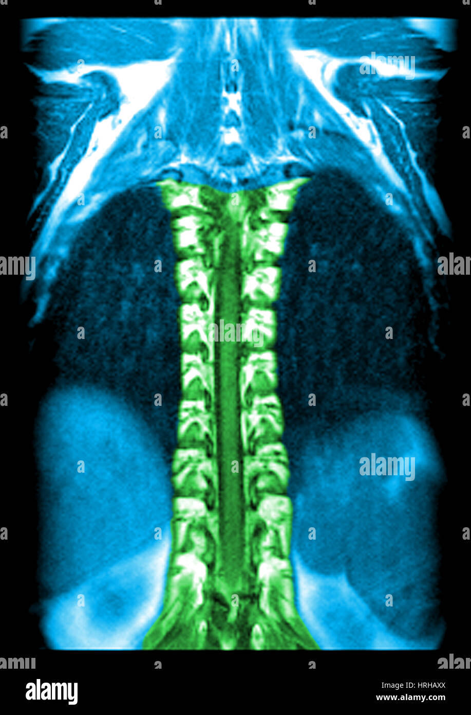 MRI des normalen thorakalen Rückenmarks Stockfoto