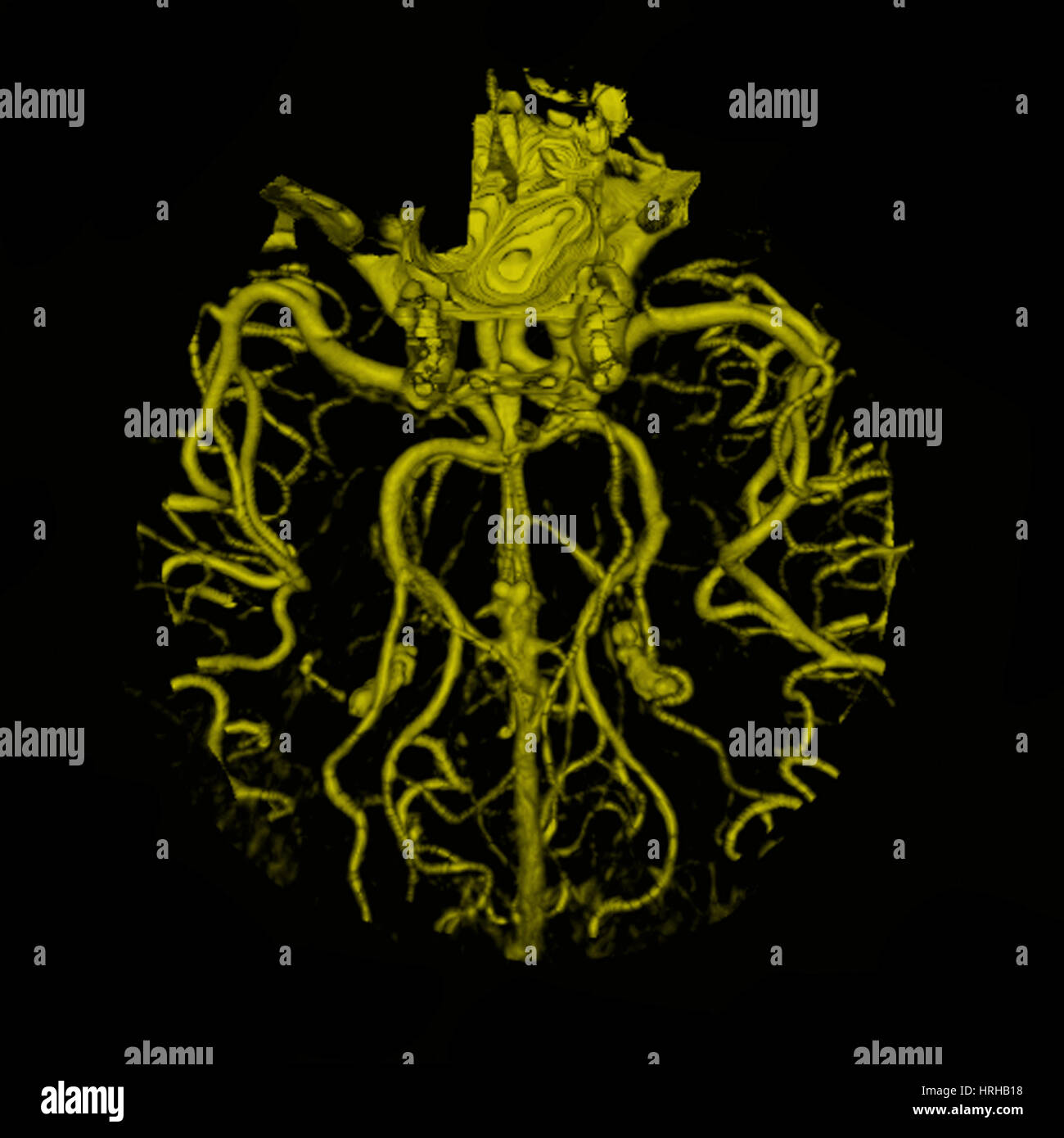 Intrakranielle CT-Angiographie Stockfoto