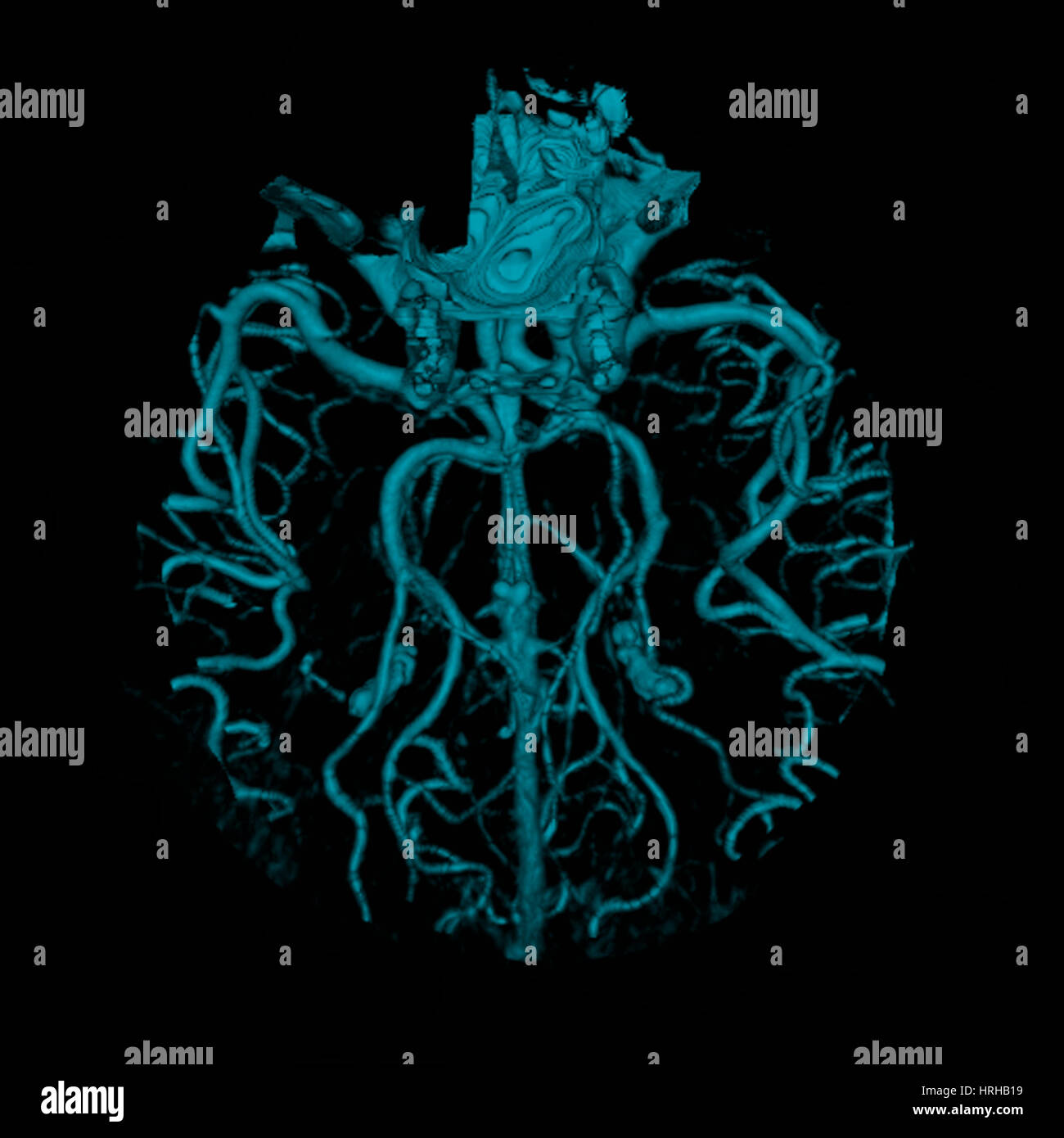Intrakraniales cta Fotos und Bildmaterial in hoher Auflösung Alamy