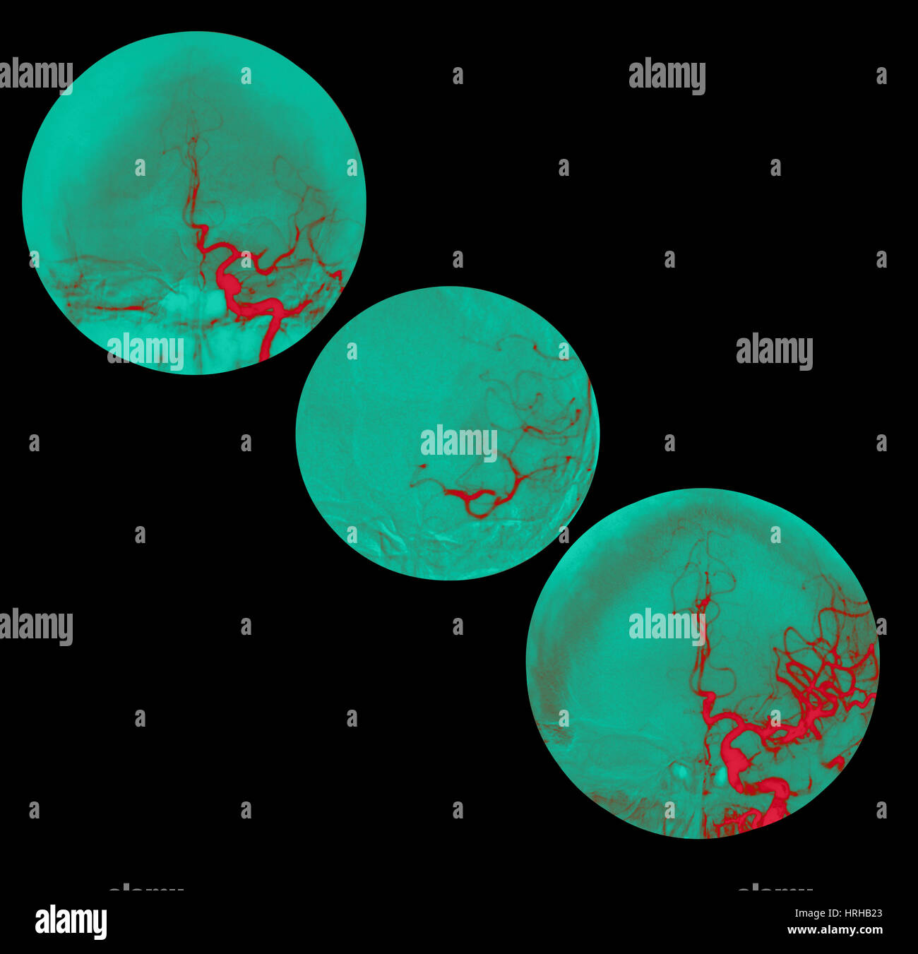 Schlaganfallbehandlung Stockfoto