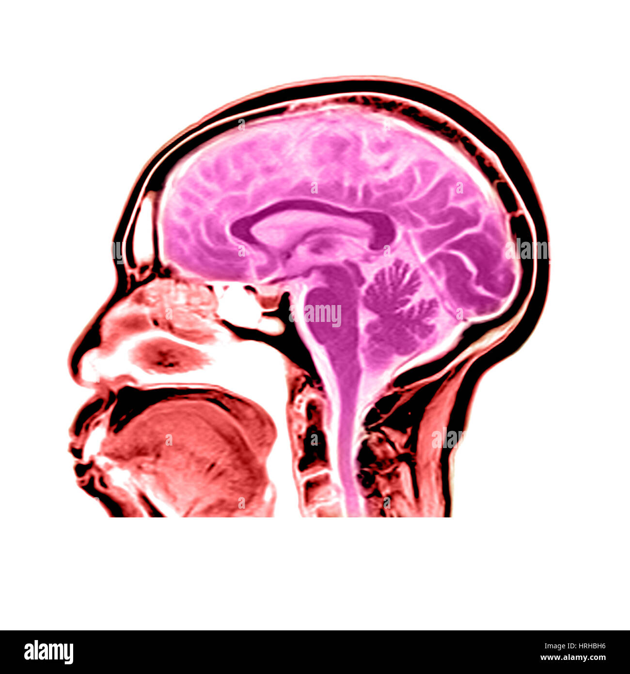 Sagittale Blick auf ein MRT des Gehirns Stockfoto