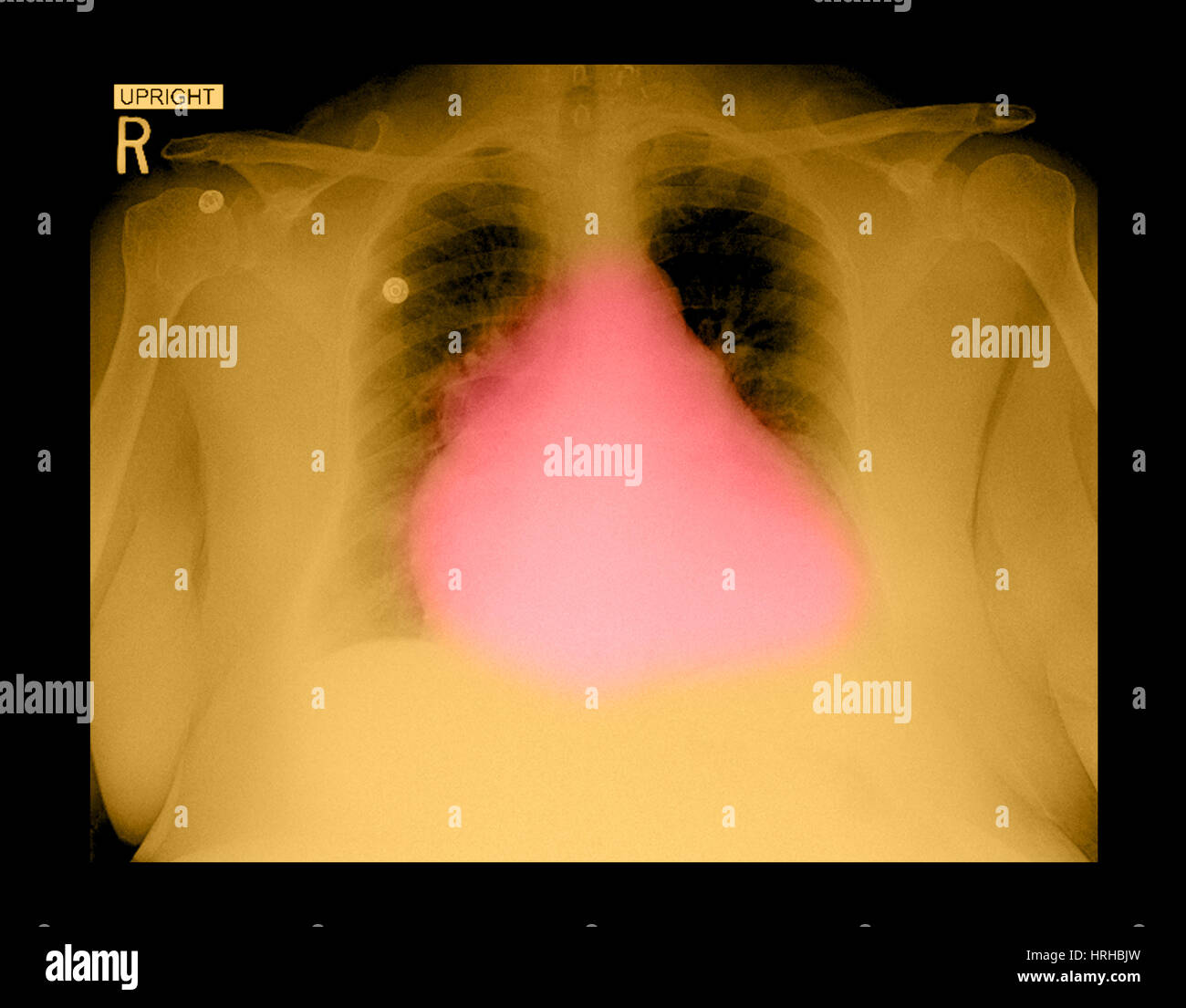 Vergrößertes Herz auf Röntgen-Thorax Stockfoto