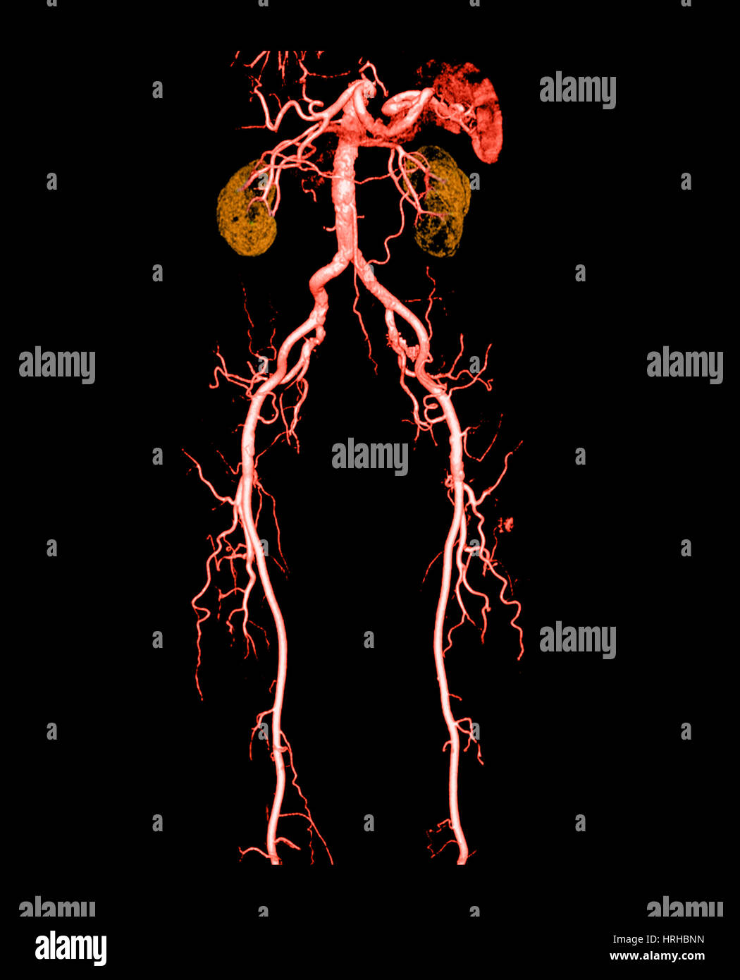 CT-Angiographie der Bauch und Beine Stockfoto