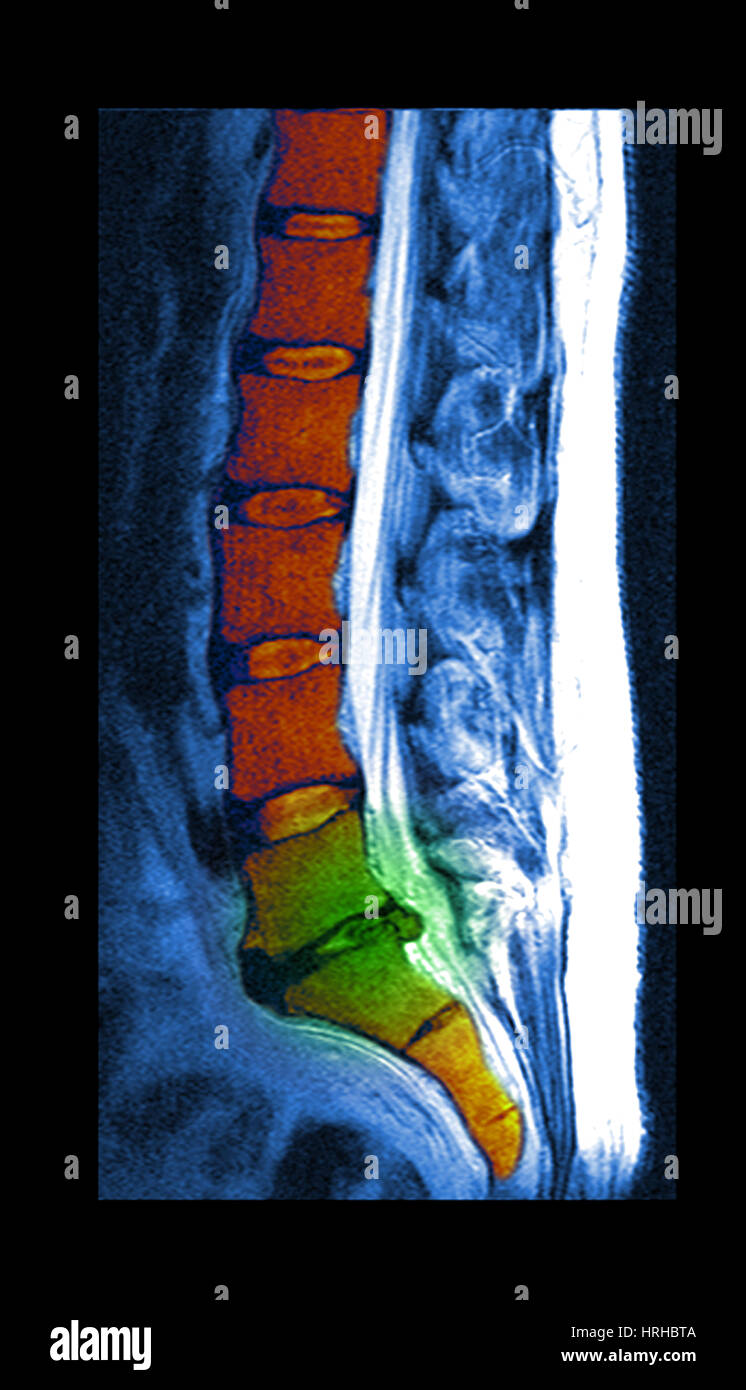 Bandscheibenvorfall Stockfoto