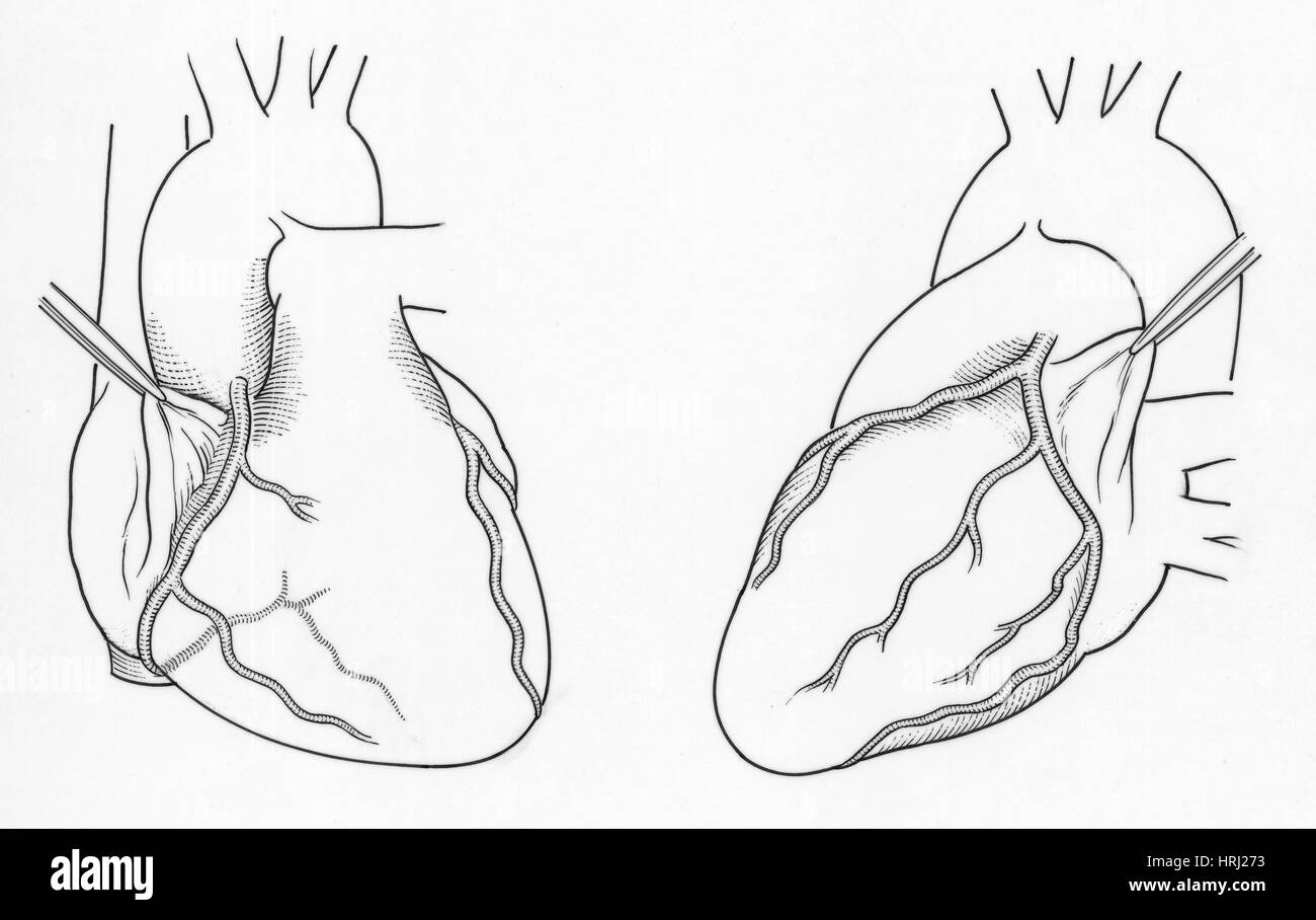 Darstellung der Herzkranzgefäße Stockfoto
