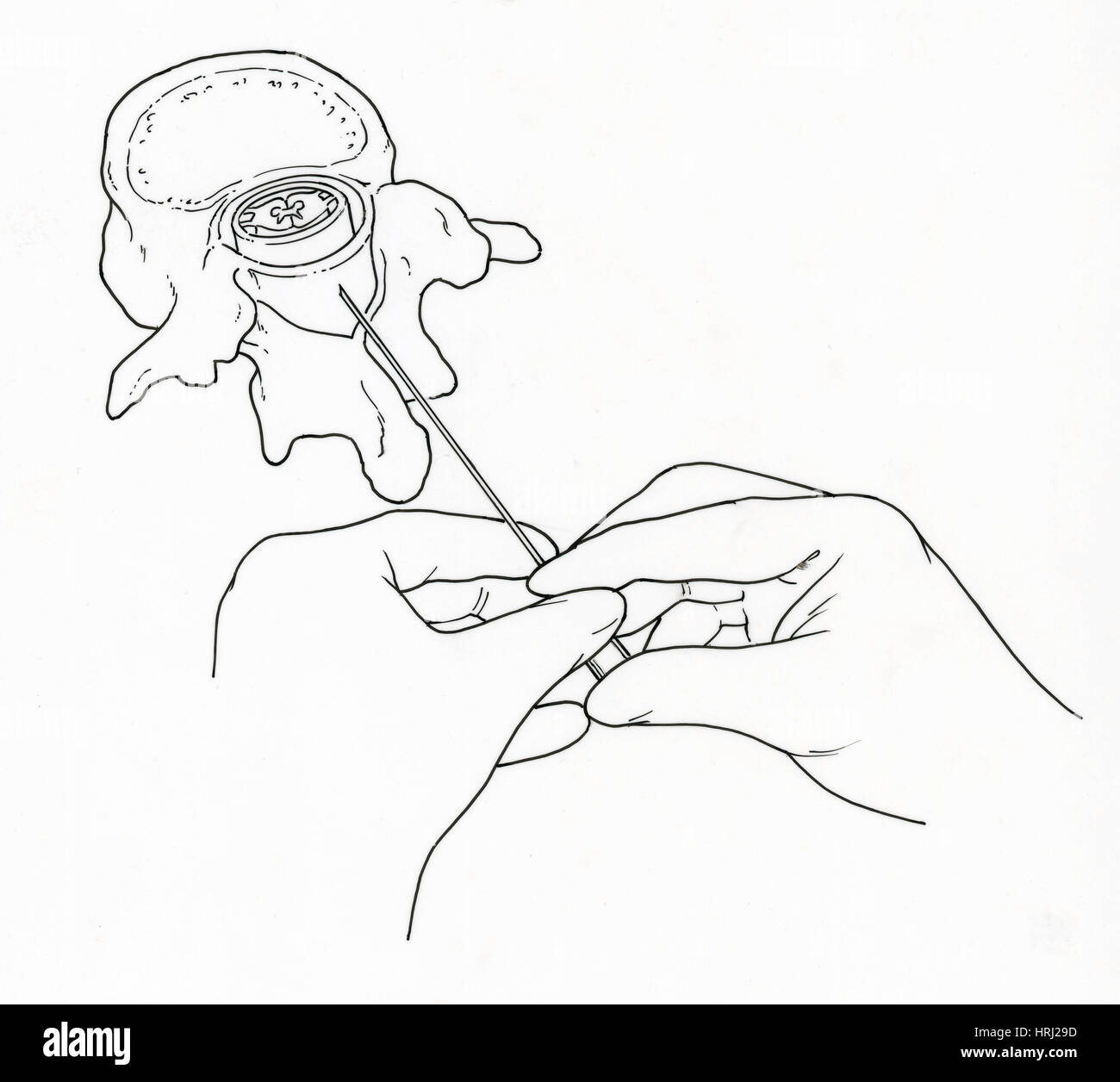 Illustration der Lumbalpunktion (Lumbalpunktion) Stockfoto