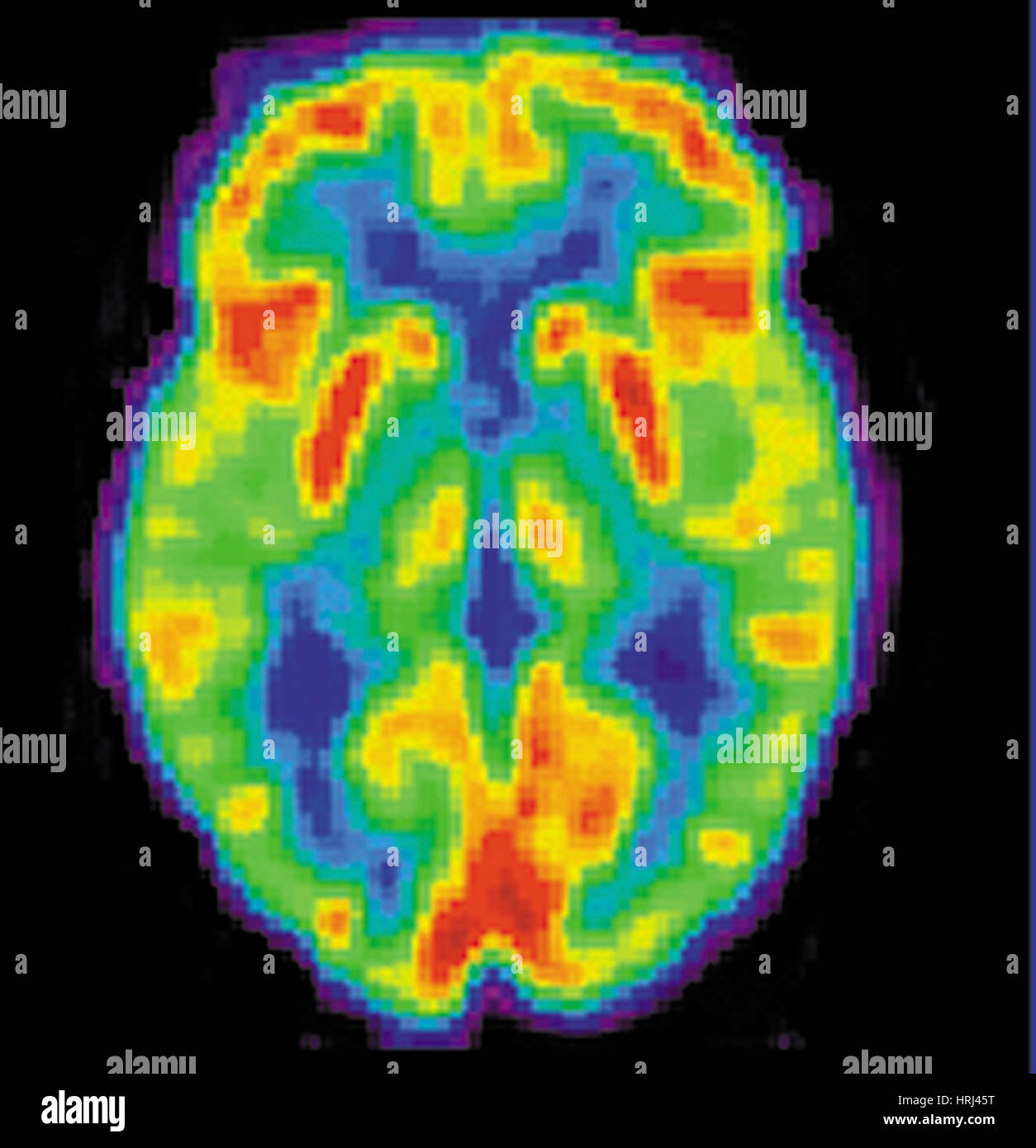 PET-Scan des 80 Jahre alten Gehirn, 2 von 2 Stockfoto