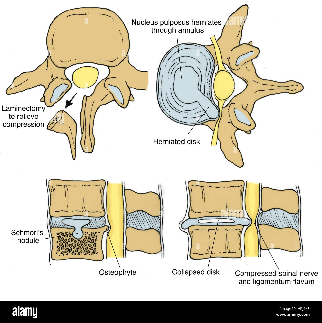Illustration der spinalen Scheibe Pathologien Stockfoto
