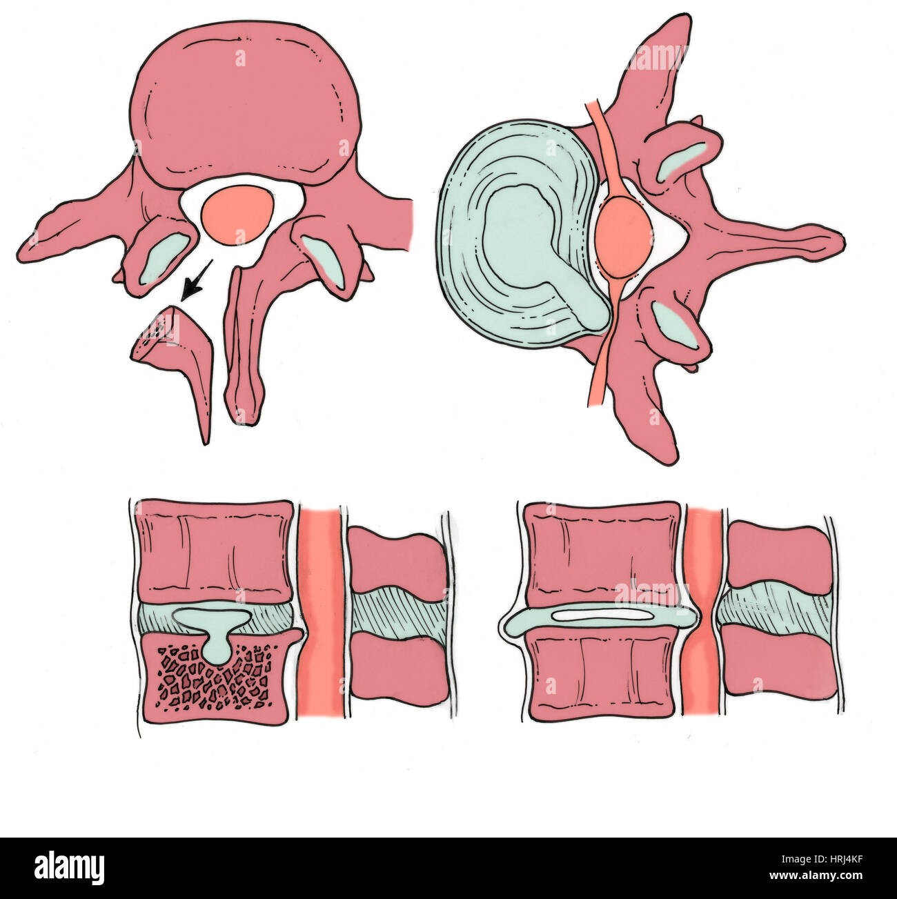 Illustration der spinalen Scheibe Pathologien Stockfoto